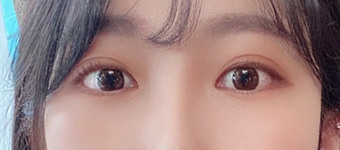 20대 매몰쌍꺼풀 눈매교정, 앞,뒤,밑트임