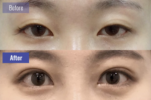 20대 매몰쌍꺼풀 눈매교정, 앞,뒤,밑트임