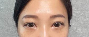 20대 절개쌍커풀,눈밑지방재배치