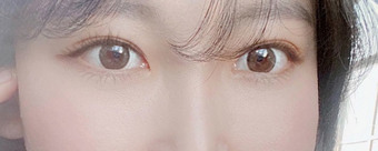 20대 매몰쌍꺼풀 눈매교정, 앞,뒤,밑트임