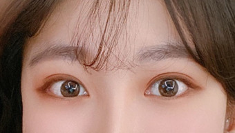 20대 매몰쌍꺼풀 눈매교정, 앞,뒤,밑트임