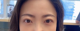 30대 눈성형 상안검 눈밑지방재배치 눈두덩이지방이식
