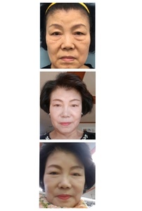눈썹거상, 하안검
