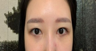 20대 눈밑지방재배치