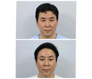 50대 상안검 이마거상