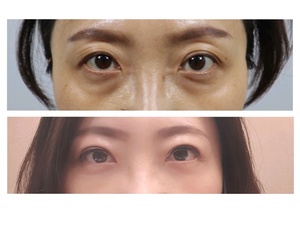 상안검  눈밑지방재배치 눈두덩이지방이식
