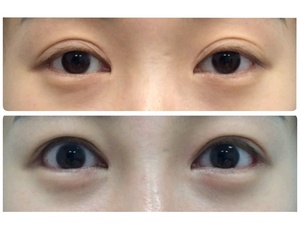 절개쌍커풀 눈매교정 애교지방이식