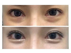 애교지방이식