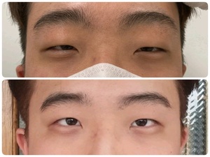 남자 쌍커풀 눈매교정