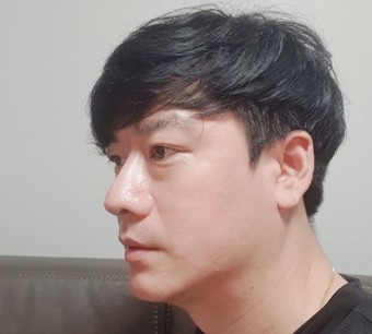 40대 코전체 콧볼축소 얼굴지방흡입